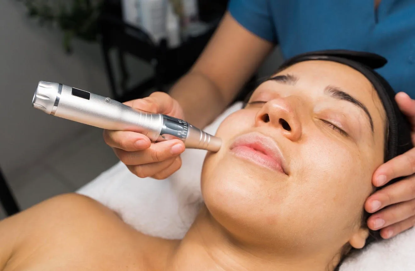 Microneedling pen treatment on the chin